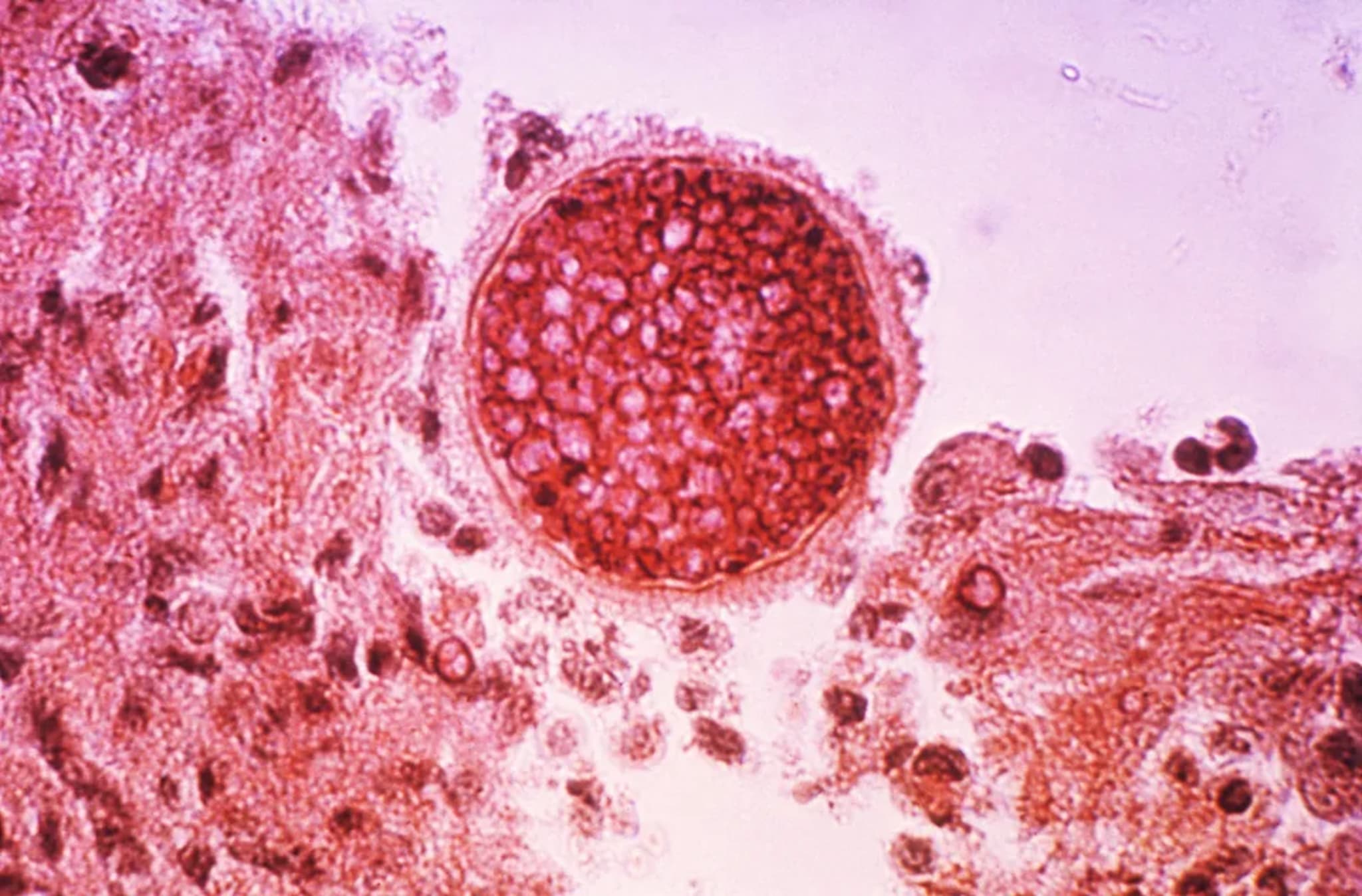 Valley Fever vaccine